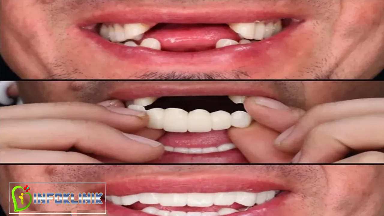 Tips Memakai Gigi Palsu dengan Nyaman